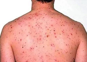 بعد تحذير منظمة الصحة العالمية..5خطوات لحماية  نفسك من جدري القرود ؟