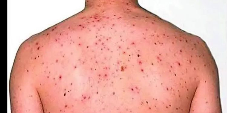 بعد تحذير منظمة الصحة العالمية..5خطوات لحماية نفسك من جدري القرود ؟