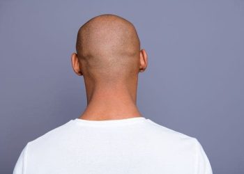 علاج جديد واعد للصلع الوراثي باستخدام هلام السكر: أمل جديد يعيد الأمل لآلاف المرضى