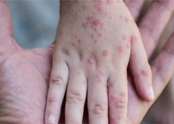 هل يوجد حالات إصابة بـ”جدري القرود” في مصر ..؟؟.. وزارة الصحة ترد