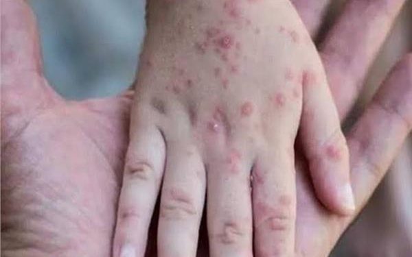 هل يوجد حالات إصابة بـ”جدري القرود” في مصر ..؟؟.. وزارة الصحة ترد